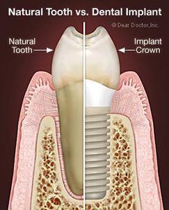 Natural tooth vs. Dental implant